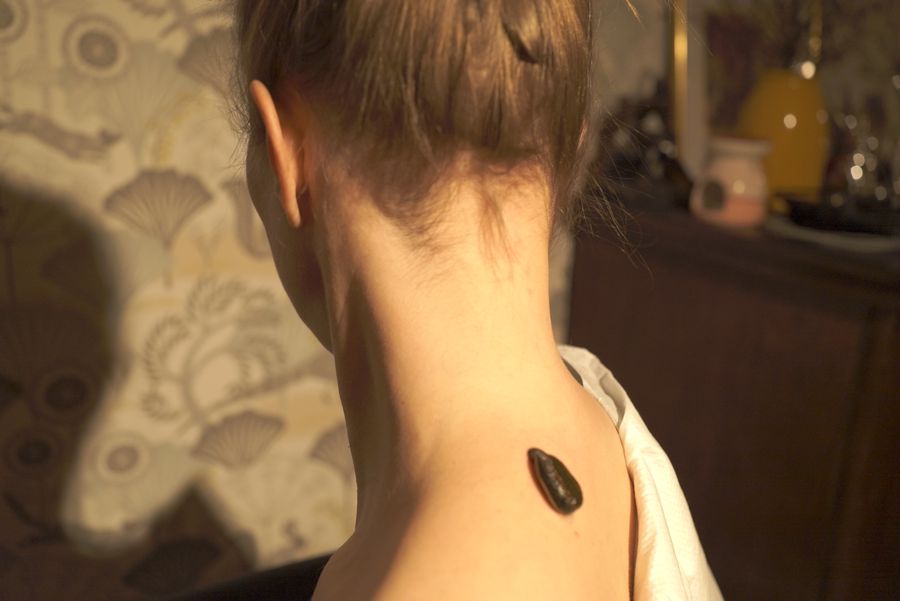 Blutegeltherapie