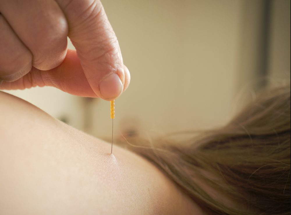 Triggerpunkt Therapie / Dry Needling